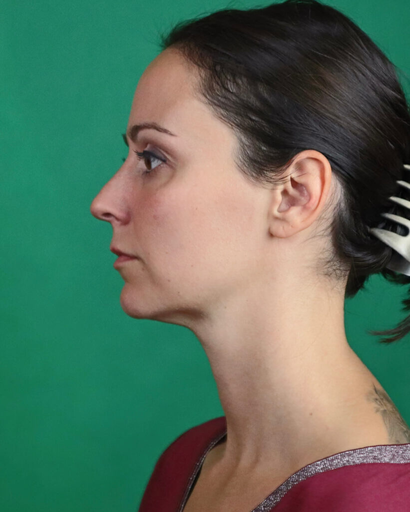 Neck before